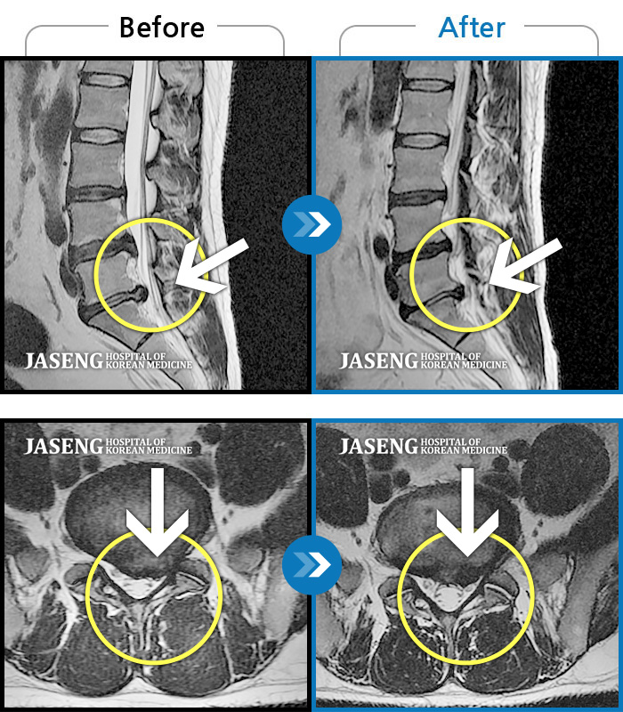 자생한방병원 치료사례 MRI로 보는 치료결과-허리통증과 양쪽 하지 방사통