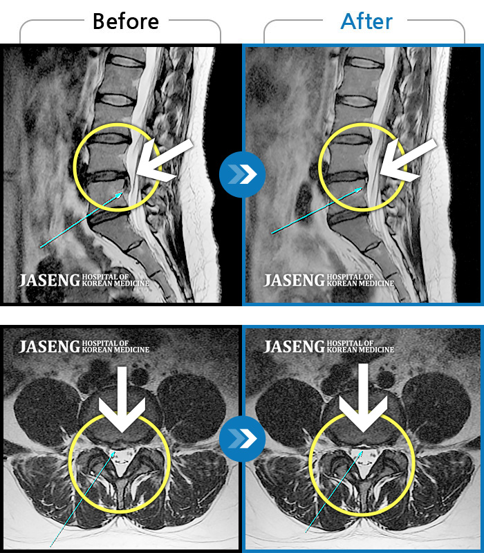 자생한방병원 치료사례 MRI로 보는 치료결과-추간판 파열로 흘러내린 디스크가 신경을 자극