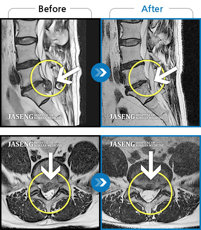 자생한방병원 치료사례 MRI로 보는 치료결과-우측 허리 골반 하지 방사통