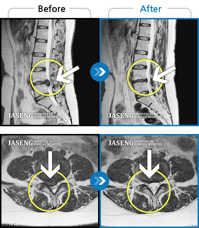자생한방병원 치료사례 MRI로 보는 치료결과-우측 허리통증 및 우측 엉치부터 발목외측까지 통증과 저림 증상
