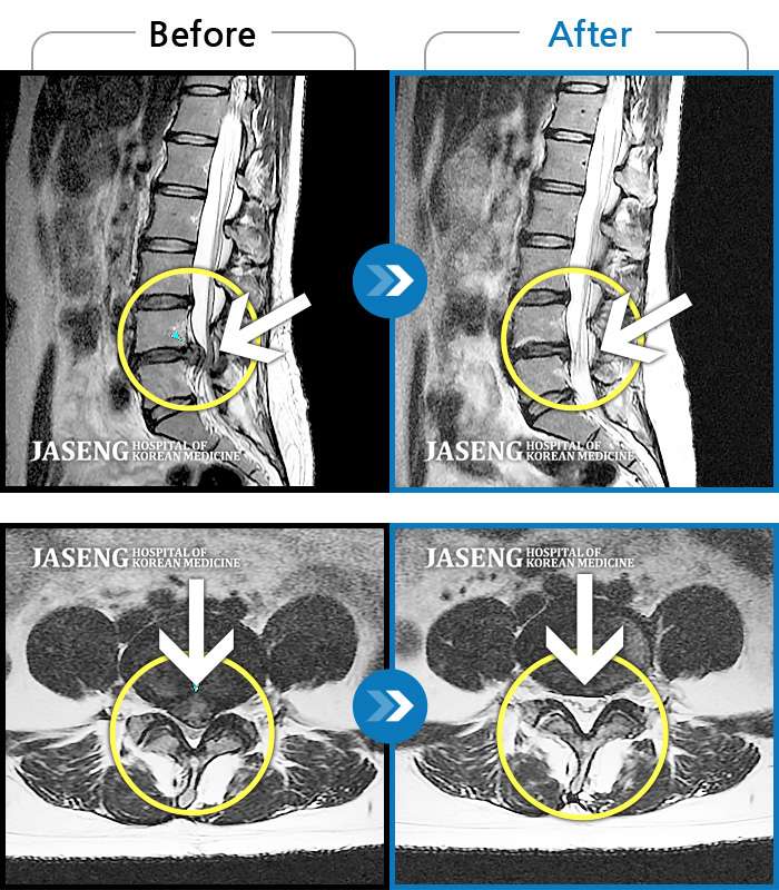 자생한방병원 치료사례 MRI로 보는 치료결과-재채기 이후 허리, 다리에 통증과 저림 증상
