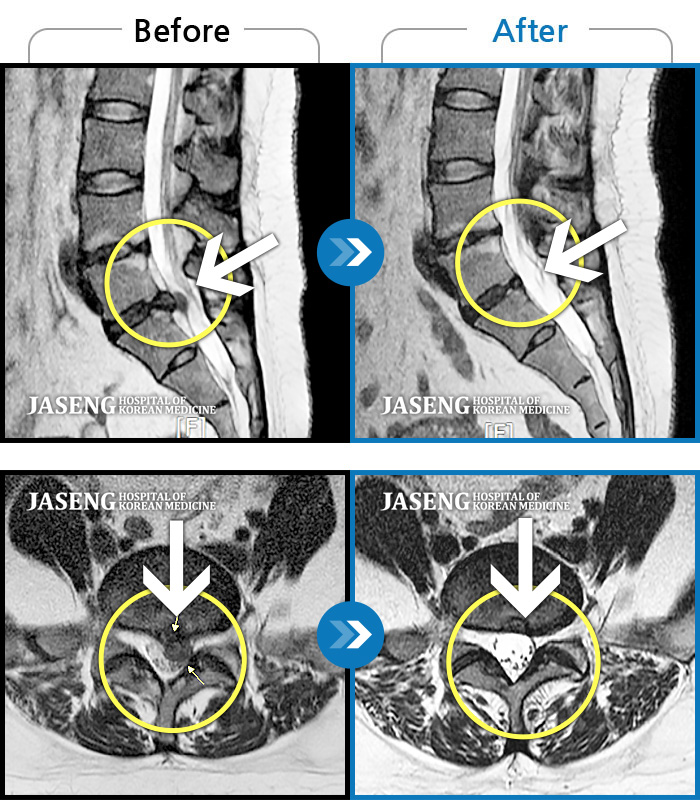 자생한방병원 치료사례 MRI로 보는 치료결과-허리디스크로 인한 다리 통증