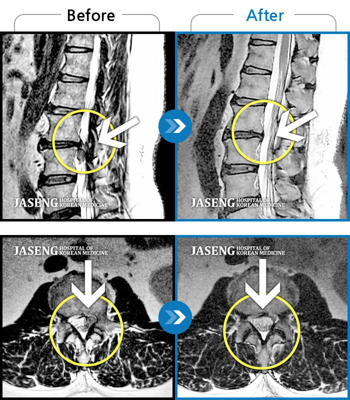 자생한방병원 치료사례 MRI로 보는 치료결과-허리 숙일 때, 앉을 때, 보행시 허리 통증 증가, 좌측 발목~무릎부위 통증