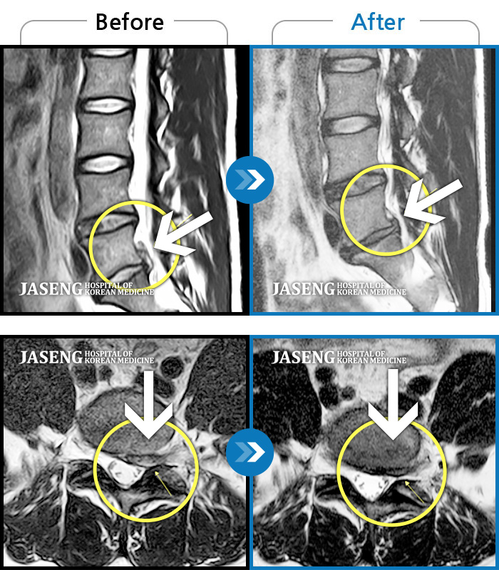 자생한방병원 치료사례 MRI로 보는 치료결과-허리통증, 왼쪽 다리 통증 및 근력 저하