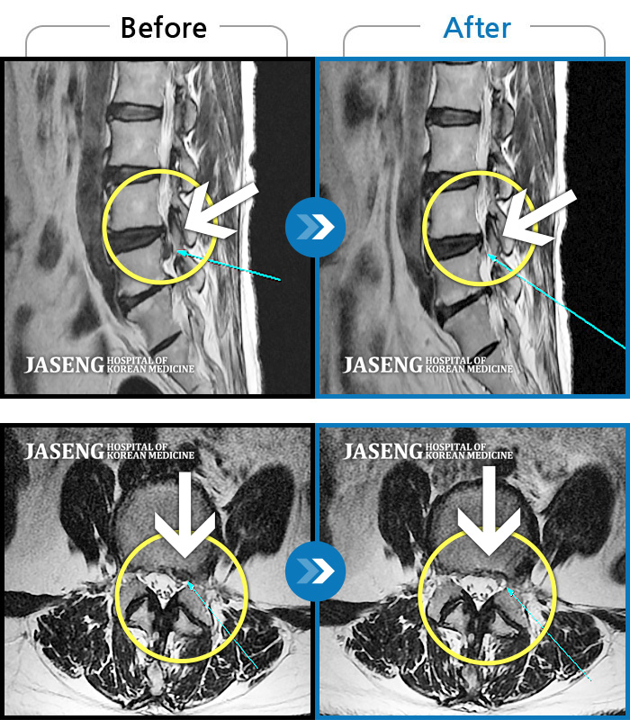 자생한방병원 치료사례 MRI로 보는 치료결과-허리 통증 및 좌측 다리 마비 증상