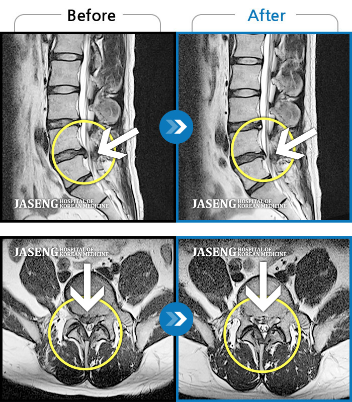 자생한방병원 치료사례 MRI로 보는 치료결과-오른쪽 종아리 당김
