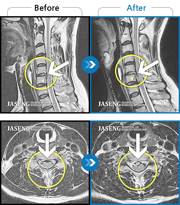 자생한방병원 치료사례 MRI로 보는 치료결과-후경부 통증 및 우상지 방사통 