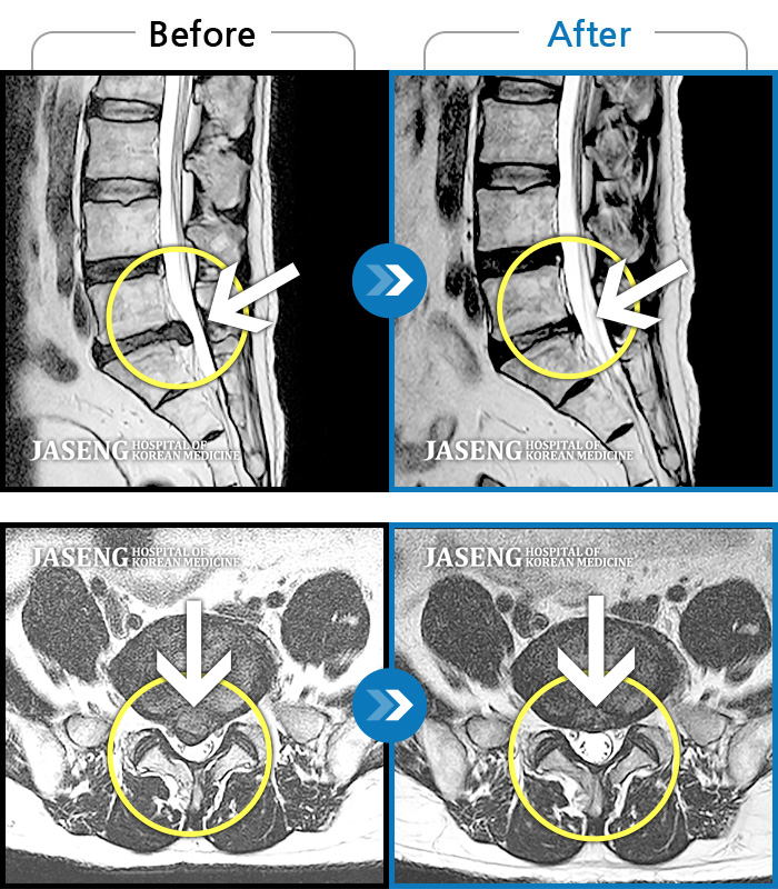 자생한방병원 치료사례 MRI로 보는 치료결과-좌측 다리 통증이 심하고 다리 감각이 무뎌요.