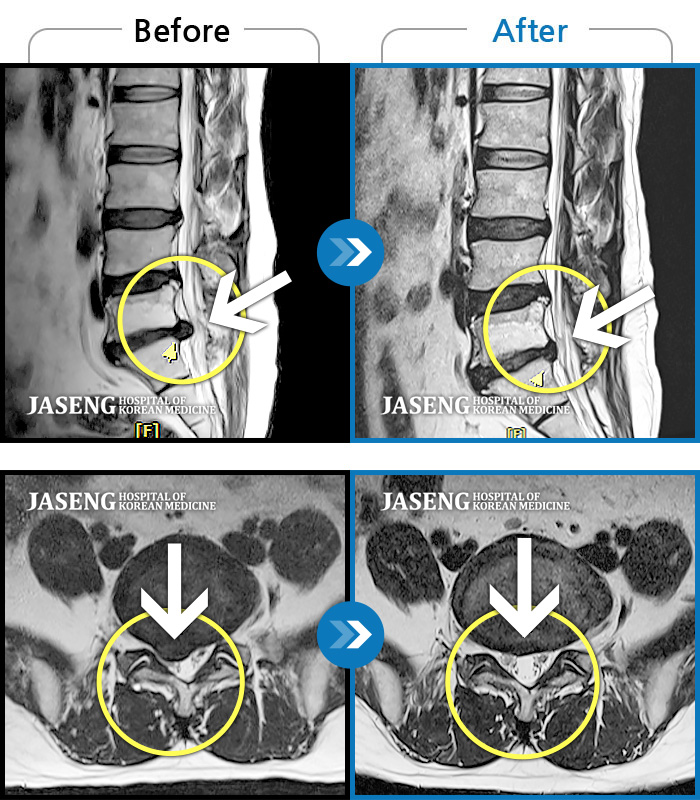 자생한방병원 치료사례 MRI로 보는 치료결과-우측 허벅지부터 종아리까지 저리고 통증, 서있을때 증상 심화