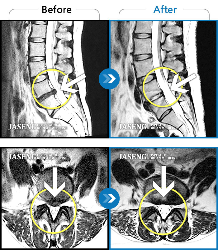 자생한방병원 치료사례 MRI로 보는 치료결과-허리와 우측 허벅지, 다리 바깥쪽으로 통증과 저림이 심했다. 