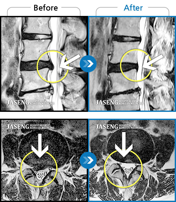 자생한방병원 치료사례 MRI로 보는 치료결과-우측 허리, 다리가 심하게 아파서 똑바로 눕지도 못하고 한달을 입원해서 치료받아야 했어요