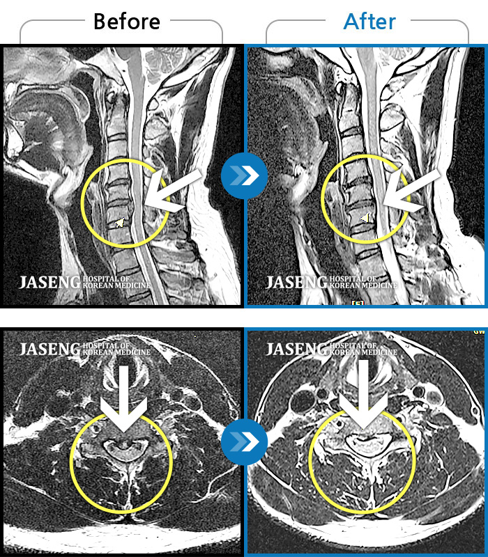 자생한방병원 치료사례 MRI로 보는 치료결과-후경부에서 견갑골까지 이어지는 묵직한 통증과 좌측 상지부위 저림