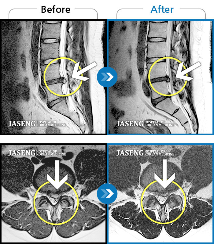 자생한방병원 치료사례 MRI로 보는 치료결과-허리와 좌측 다리가 당겨 보행이 불가능했다.