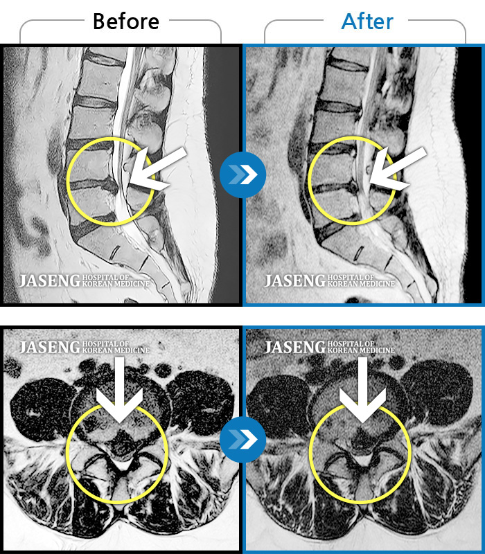 자생한방병원 치료사례 MRI로 보는 치료결과-오래 앉으면 다리로 저림이 내려와요