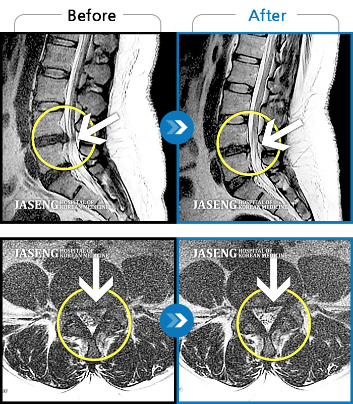 자생한방병원 치료사례 MRI로 보는 치료결과-좌측 다리 저림 및 마비 감각을 동반한 좌측 하요부 통증. 