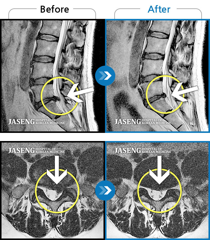 자생한방병원 치료사례 MRI로 보는 치료결과-허리와 엉치 부위 통증이 심해서 잠도 제대로 못자고 좋아하는 골프도 전혀 치지 못했어요.