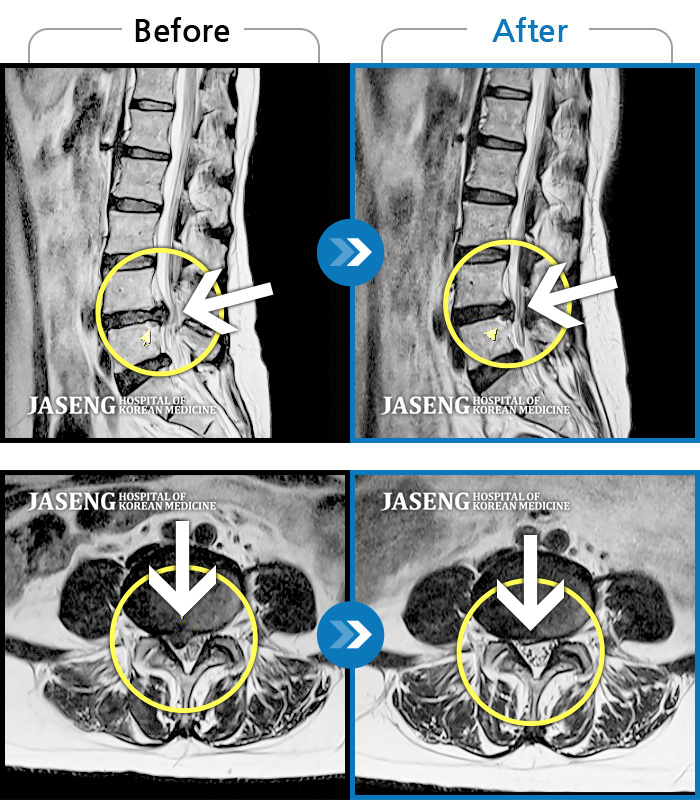 자생한방병원 치료사례 MRI로 보는 치료결과-허리 양측부터 골반까지 통증, 우측 하지 내측으로 이어지는 당기는 통증 및 저린감