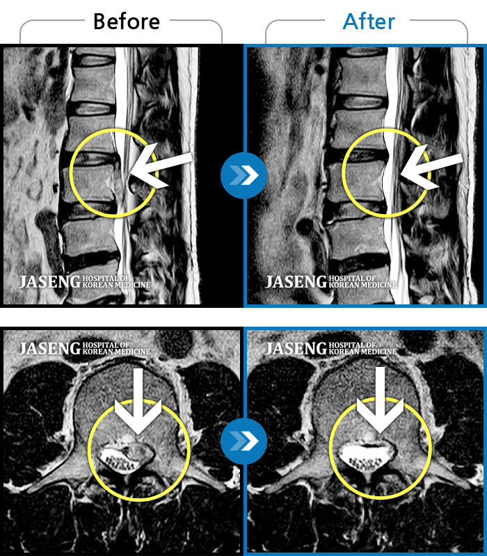 자생한방병원 치료사례 MRI로 보는 치료결과-왼쪽 허리, 골반, 허벅지까지 아프고 왼쪽 다리 힘이 빠져요.