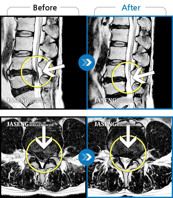 자생한방병원 치료사례 MRI로 보는 치료결과-허리에서 왼쪽 다리, 발까지 저리고 왼쪽 발목, 엄지발가락 힘이 안들어가요.
