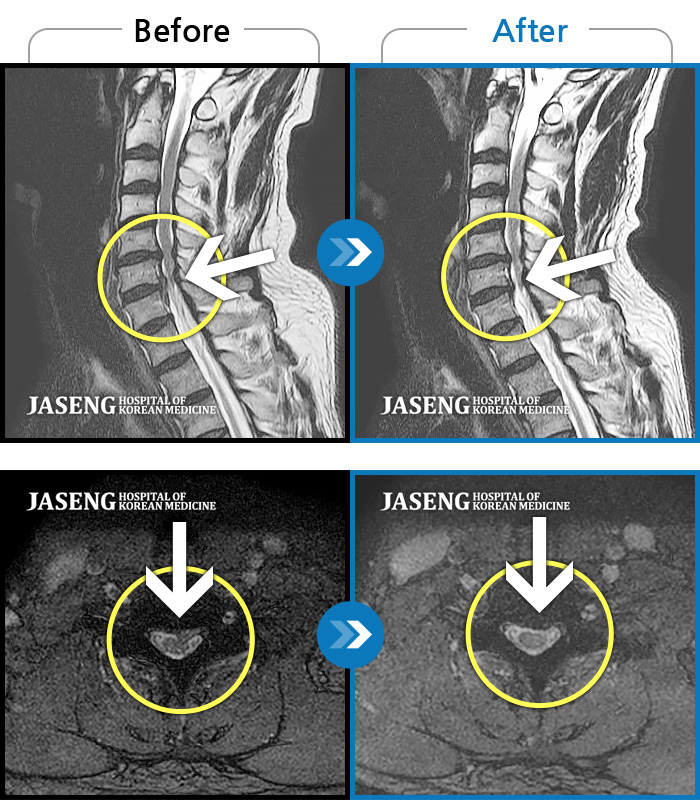 자생한방병원 치료사례 MRI로 보는 치료결과-왼쪽 목, 어깨, 등 통증과  팔저림이 심해서 잠을 못자요. 