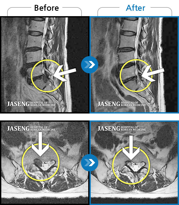 자생한방병원 치료사례 MRI로 보는 치료결과-우측 엉치부터 우측 다리부터 발끝까지 저리고 아프다. 감각까지 먹먹하다.