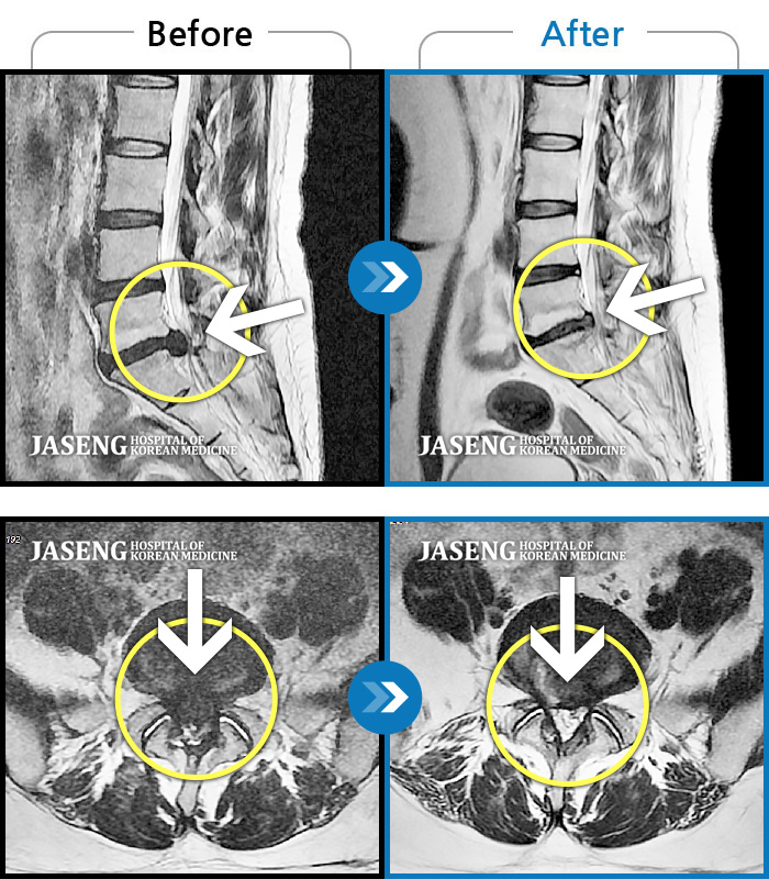 자생한방병원 치료사례 MRI로 보는 치료결과-발가락 마비, 꼬리뼈 부근 통증
