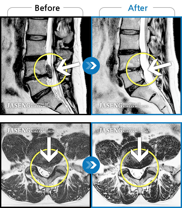 자생한방병원 치료사례 MRI로 보는 치료결과-좌측 골반통증으로 보행 시 다리를 뻗을 수가 없고 극심한 요통 및 종아리 통증으로 자세변경을 바로 할 수가 없는 상태