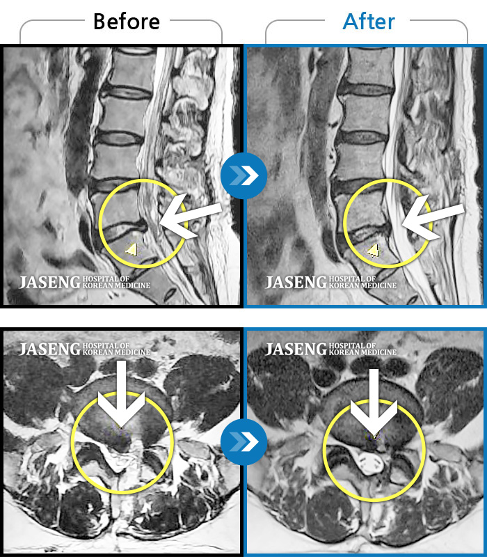 자생한방병원 치료사례 MRI로 보는 치료결과-양측 허리부터 골반까지 통증, 좌측 둔부부터 족부 말단까지 저리고 당김
