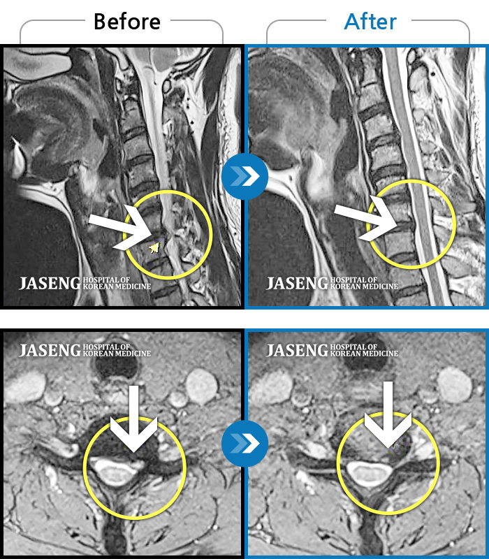 자생한방병원 치료사례 MRI로 보는 치료결과-양측 후경부 부터 견갑골 내연까지 이어지는 묵직한 통증