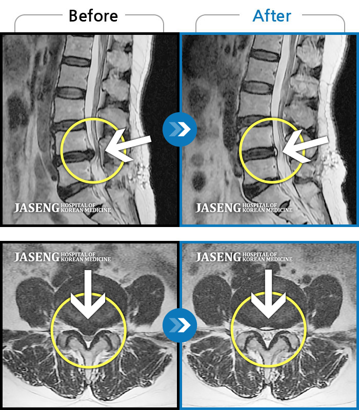 자생한방병원 치료사례 MRI로 보는 치료결과-허리가 아프고 두 다리가 저려서 조금만 걸어도 주저 앉아야 했습니다.