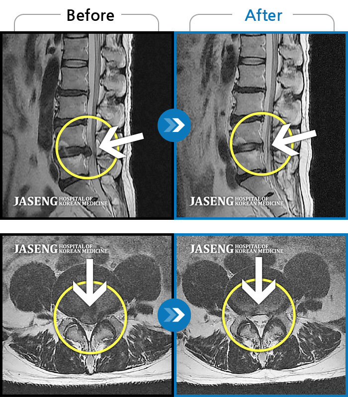 자생한방병원 치료사례 MRI로 보는 치료결과-처음 내원 시 허리, 엉덩이가 많이 아프고, 좌측 다리로 근력 및 감각 저하도 있었으며, 야간통을 잠도 못자고 통증 심하여 식사도 무릎꿇고 하는 등 정상적인 활동이 힘든 상태셨습니다. 