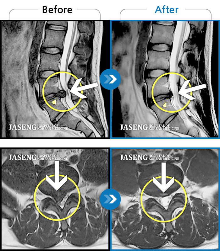자생한방병원 치료사례 MRI로 보는 치료결과-우측 허리부터 우측 종아리까지 통증, 걸을 때 통증 심화 