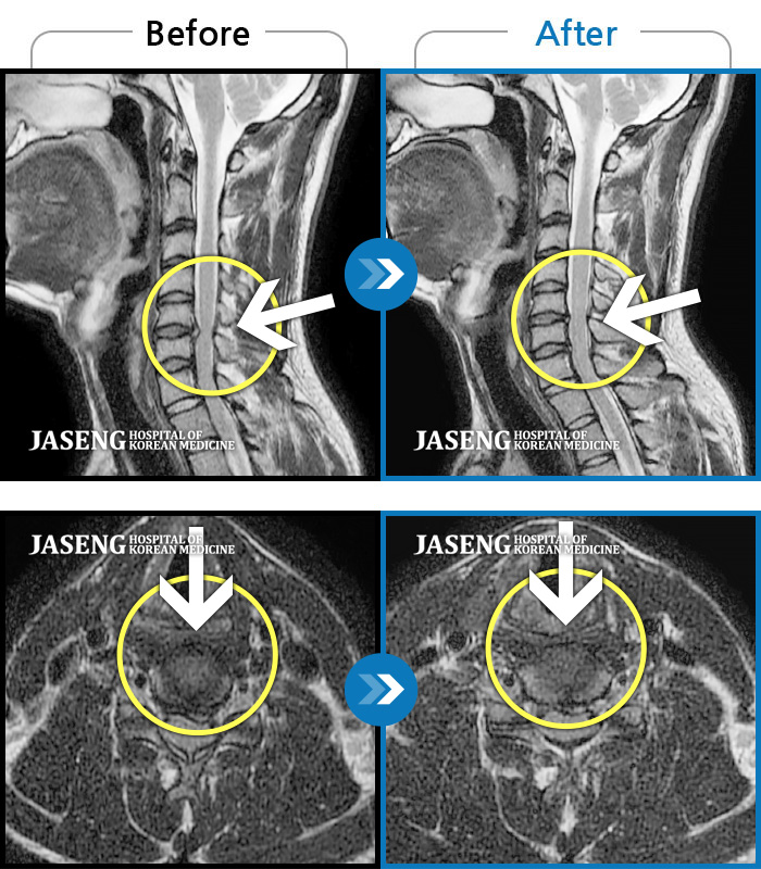 자생한방병원 치료사례 MRI로 보는 치료결과-목 통증 및 좌측 팔 저림으로 숨 쉬는 것도 불편하고 움직일 수가 없는 상태로 내원하셨습니다.