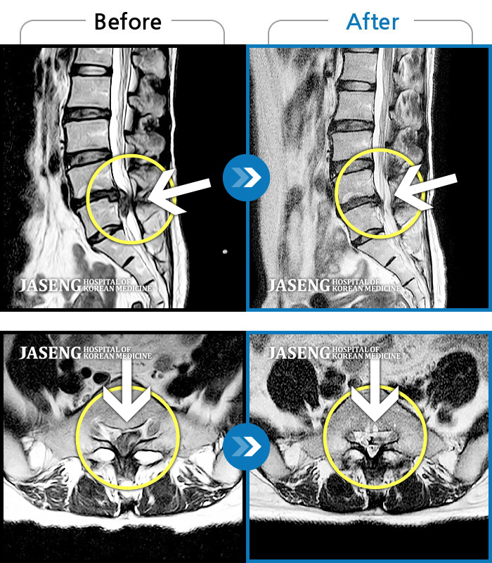 자생한방병원 치료사례 MRI로 보는 치료결과-허리통증, 골반 저림, 발가락 근력저하가 심하여 일상생활이 불가능한 상태