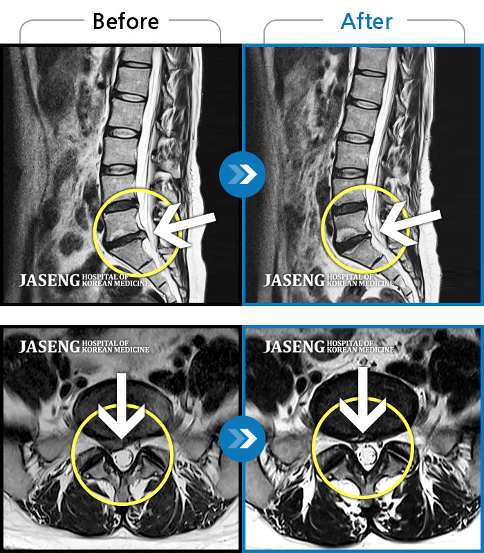 자생한방병원 치료사례 MRI로 보는 치료결과-우측 허리 뻐근한 통증, 우측 허벅지부터 발목까지 이어지는 당김