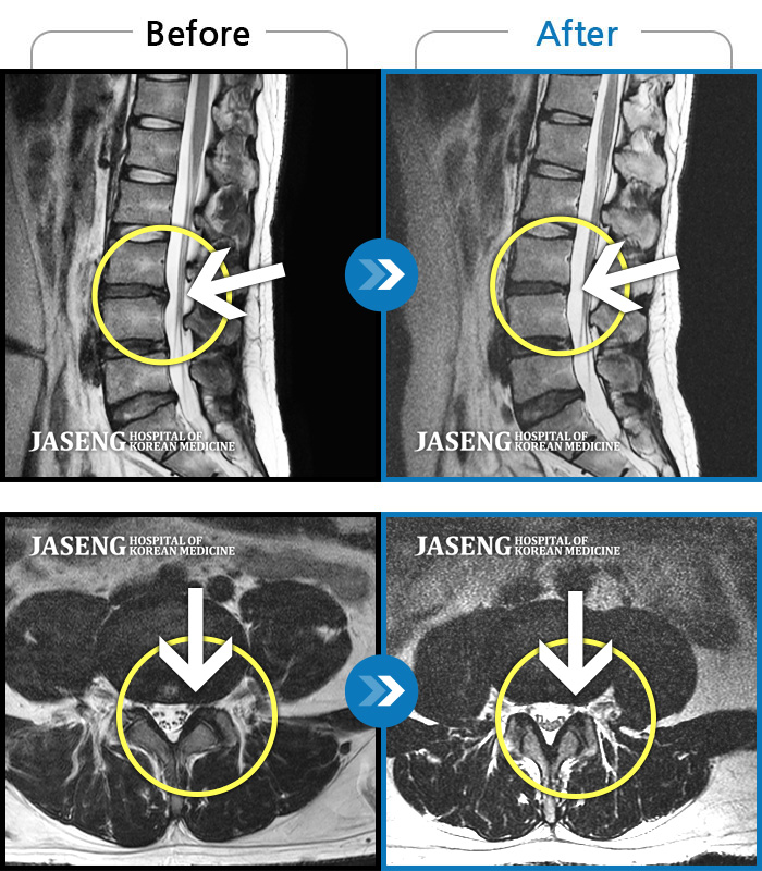 자생한방병원 치료사례 MRI로 보는 치료결과-스스로 침대에 오르내리지 못하고 심한 야간통으로 일상생활이 불가능했던 상태