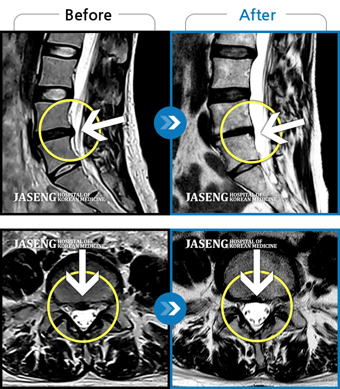 자생한방병원 치료사례 MRI로 보는 치료결과-허리통증 및 골반부위 통증으로 일상생활이 불가능했습니다.