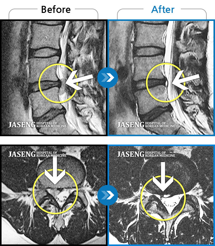 자생한방병원 치료사례 MRI로 보는 치료결과-허리굽히는 동작을 한 후 우측 골반통증 및 우측 하지외측 저림, 근력저하가 있었다.