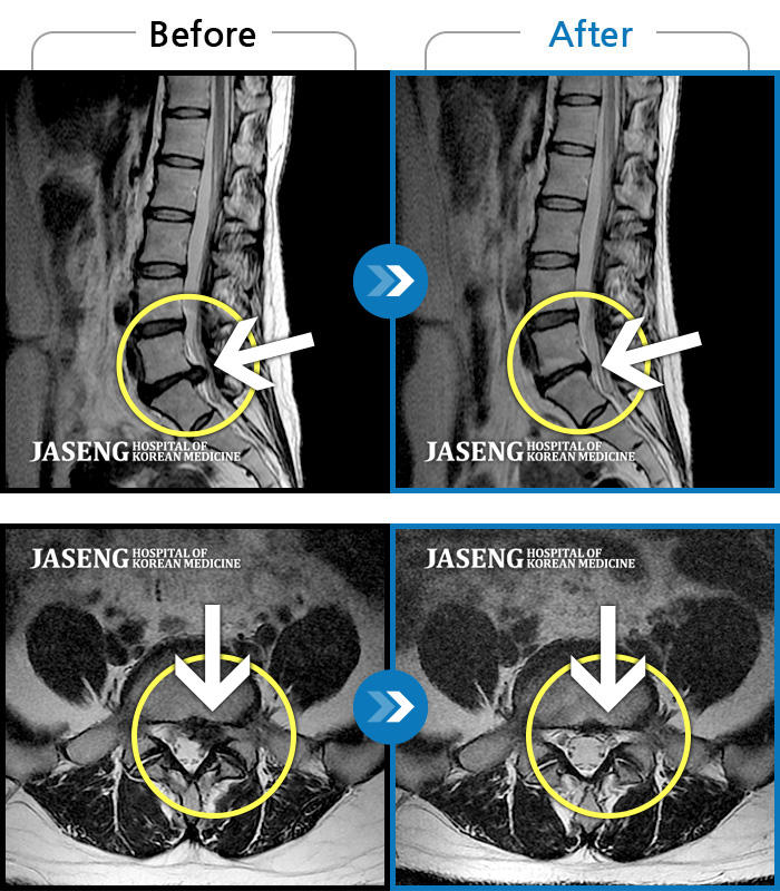 자생한방병원 치료사례 MRI로 보는 치료결과-처음 내원 시 좌측 엉덩이가 많이 아프고, 좌측 다리로 저림이 심하며 특히 좌위시 하지 방사통이 심하여 1분도 좌위가 어려워 식사도 서서 하는 등 정상적인 활동이 힘든 상태였습니다. 