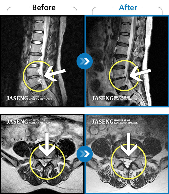 자생한방병원 치료사례 MRI로 보는 치료결과-허리 통증과 좌측 대퇴부~종아리 저림과 통증