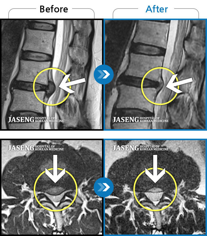 자생한방병원 치료사례 MRI로 보는 치료결과-양측 다리가 당기는데 왼쪽이 더 심해요.