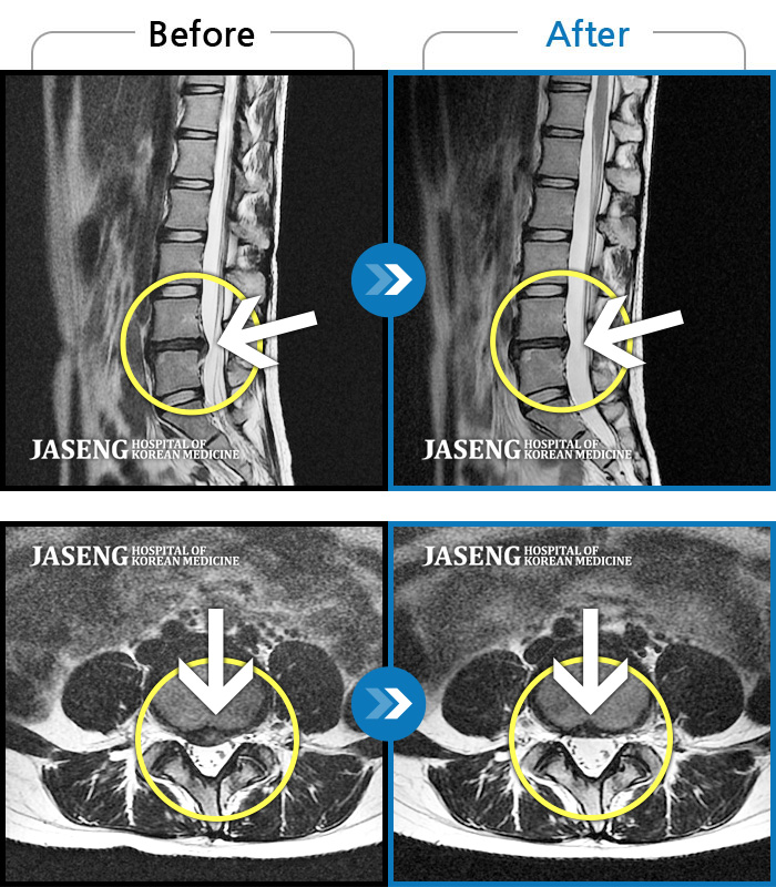 자생한방병원 치료사례 MRI로 보는 치료결과-허리 통증과 좌측 대퇴부 저림과 당김