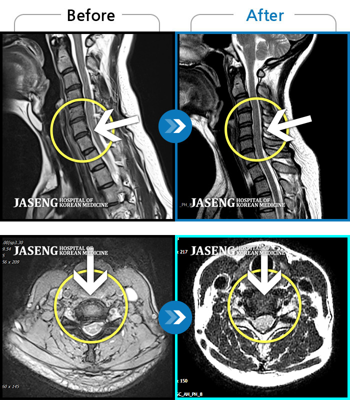 자생한방병원 치료사례 MRI로 보는 치료결과-처음 내원시 목에서 등으로 이어지는 통증 및 우측 팔 저림 증상이 심했고, 약간의 근력저하도 동반되어 일상생활이 어려운 상태였습니다.