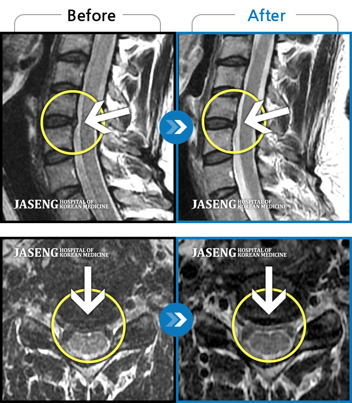 자생한방병원 치료사례 MRI로 보는 치료결과-왼쪽 목부터 견갑골 안쪽까지 아프고 왼팔을 올릴때 팔부터 손 끝까지 저린감이 내려간다.
