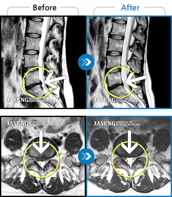 자생한방병원 치료사례 MRI로 보는 치료결과-무리한 회사 생활로 허리 통증과 우측 다리 저림으로 내원