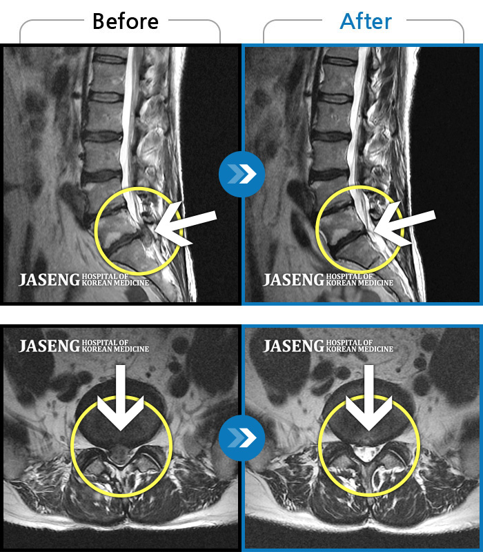 자생한방병원 치료사례 MRI로 보는 치료결과-다리가 아프고 힘이 빠져서 지팡이를 짚고 걸어야 했고, 밤에 잠을 못잤어요