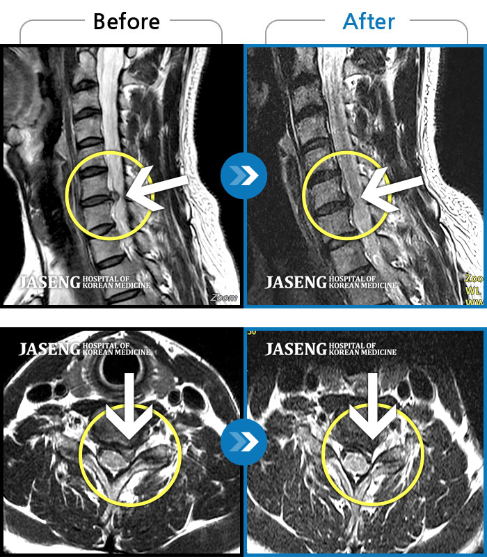 자생한방병원 치료사례 MRI로 보는 치료결과-좌측 목, 어깨, 상지 찌릿한 방사통으로 일상생활 지장, 야간통이 심하다