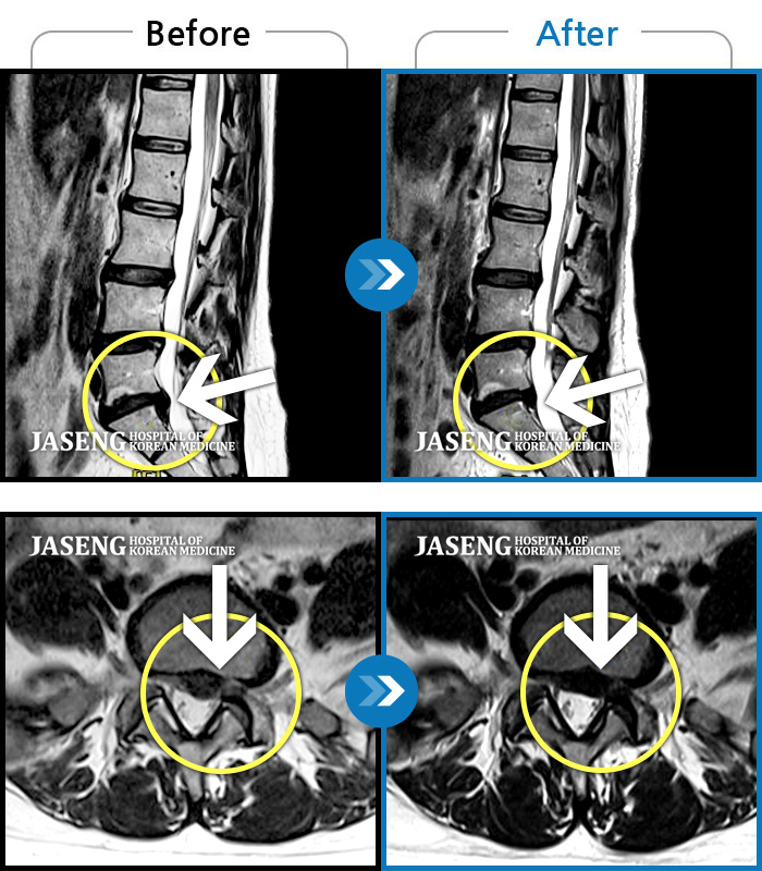 자생한방병원 치료사례 MRI로 보는 치료결과-좌측 허리부터 골반과 다리까지 이어지는 당기는 통증으로 내원하셨습니다.