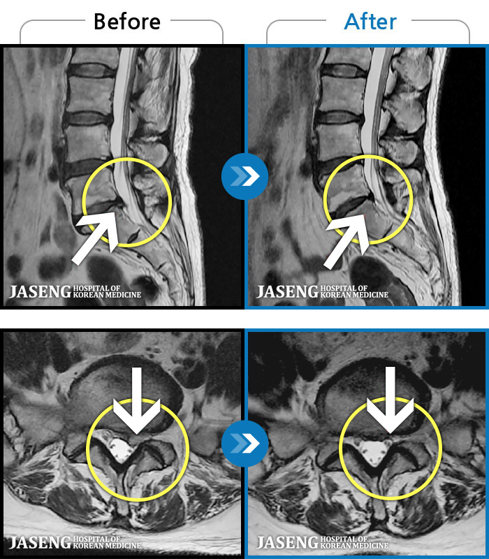 자생한방병원 치료사례 MRI로 보는 치료결과-엉덩이의 왼쪽 부위 및 하지방사통이 심각하여 보행이 불가한 상태에서 내원하셨습니다. 