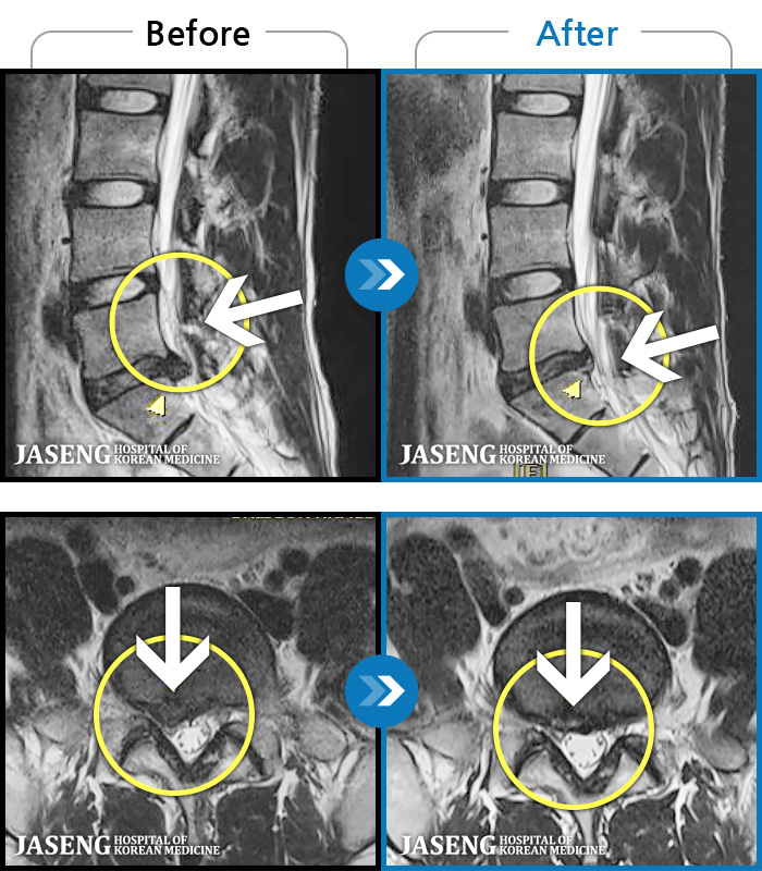 자생한방병원 치료사례 MRI로 보는 치료결과-허리부터 골반 및 우측 허벅지에서 발가락까지 묵직한 통증과 저림 발생하여 내원하셨습니다.